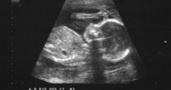 Mothers choose Life when they view a sonogram